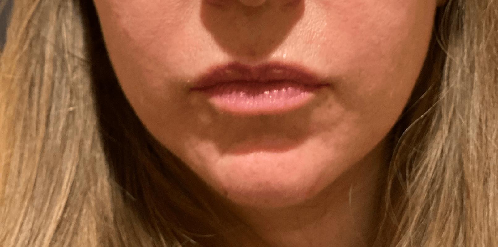 Before and after derma filler chin