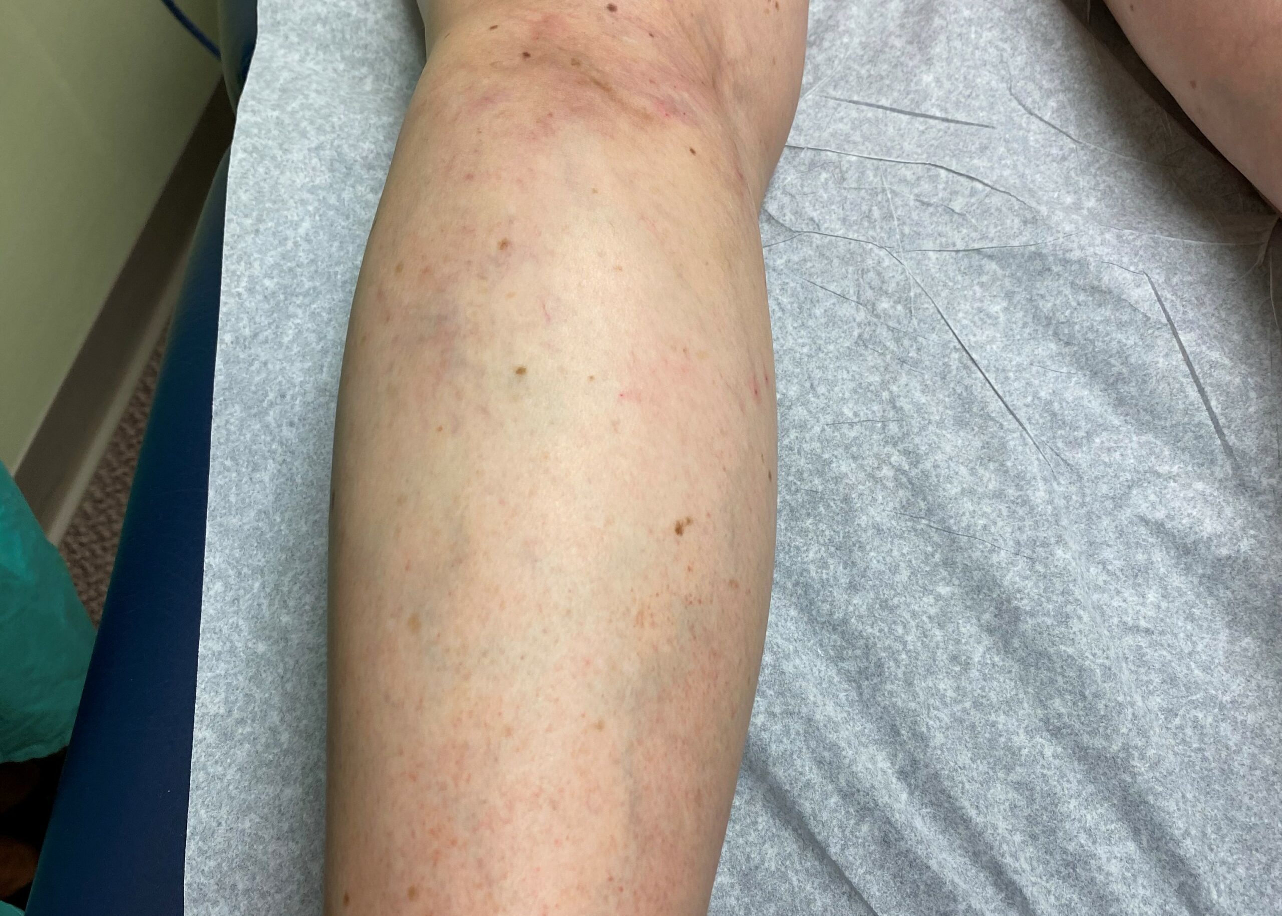 After sclerotherapy therapy jpg file